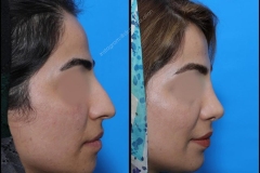 nose-surgery-0082