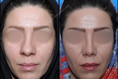 nose-surgery-0083