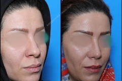 nose-surgery-0084