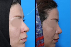 nose-surgery-0085