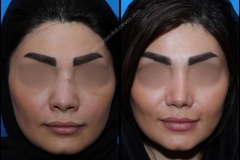 nose-surgery-0086