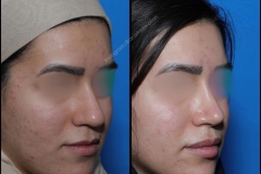 nose-surgery-0087