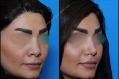 nose-surgery-0088