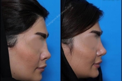 nose-surgery-0089