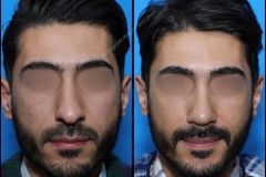 nose-surgery-0090