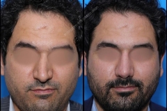 nose-surgery-0093