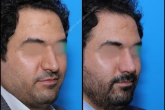 nose-surgery-0094