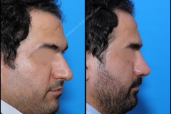 nose-surgery-0095