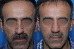nose-surgery-0096