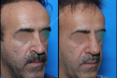 nose-surgery-0097