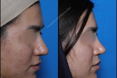 nose-surgery-0098