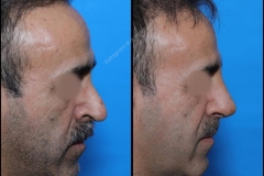 nose-surgery-0099