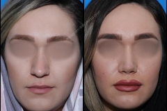 nose-surgery-0100