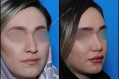 nose-surgery-0101