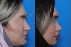 nose-surgery-0102