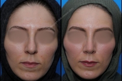 nose-surgery-0103