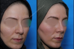 nose-surgery-0104