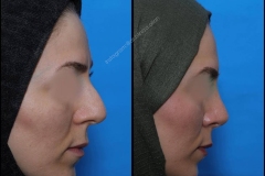 nose-surgery-0105