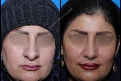 nose-surgery-0106