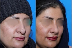 nose-surgery-0107