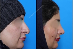 nose-surgery-0108