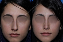 nose-surgery-0109