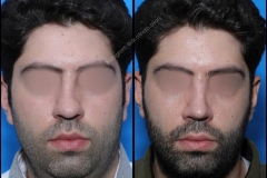 nose-surgery-0110
