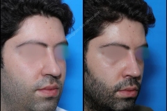 nose-surgery-0111