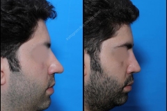 nose-surgery-0112