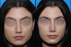 nose-surgery-0113