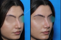 nose-surgery-0114