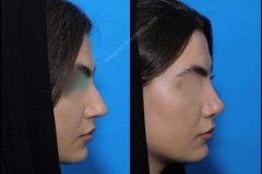nose-surgery-0115