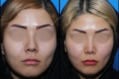nose-surgery-0116