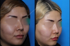 nose-surgery-0117