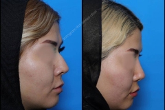 nose-surgery-0118