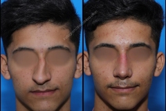 nose-surgery-0119