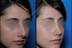 nose-surgery-0120