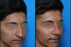 nose-surgery-0121