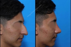 nose-surgery-0122