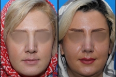 nose-surgery-0123