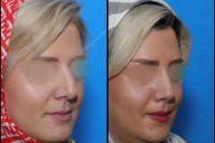 nose-surgery-0124