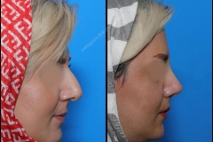 nose-surgery-0125