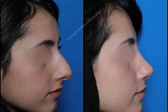 nose-surgery-0126