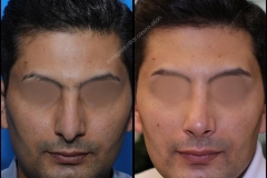 nose-surgery-0127