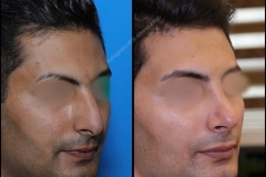 nose-surgery-0128