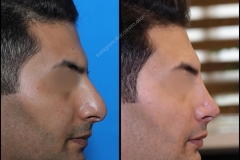 nose-surgery-0129