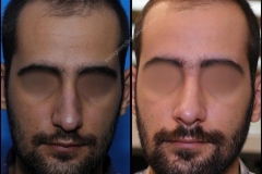nose-surgery-0130