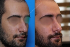 nose-surgery-0131