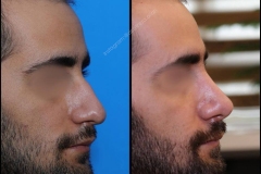 nose-surgery-0132