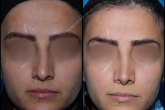 nose-surgery-0133